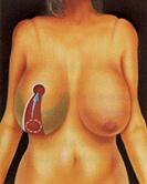 Уменьшение груди - Пластический хирург Ткач Олег Сергеевич Уменьшение груди