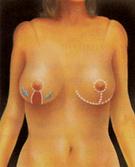 Уменьшение груди - Пластический хирург Ткач Олег Сергеевич Уменьшение груди