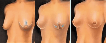 Подтяжка груди, мастопексия