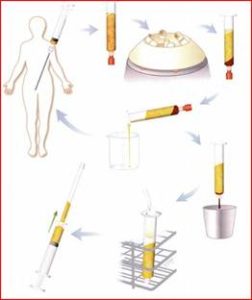 Липофилинг - Пластический хирург Ткач Олег Сергеевич Липофилинг