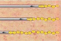 Липофилинг - Пластический хирург Ткач Олег Сергеевич Липофилинг