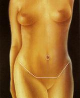 Абдоминопластика (пластика живота) - Пластический хирург Ткач Олег Сергеевич Абдоминопластика (пластика живота)