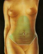 Абдоминопластика (пластика живота) - Пластический хирург Ткач Олег Сергеевич Абдоминопластика (пластика живота)