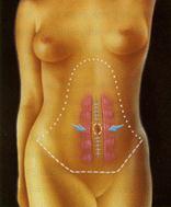 Абдоминопластика (пластика живота) - Пластический хирург Ткач Олег Сергеевич Абдоминопластика (пластика живота)