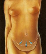 Абдоминопластика (пластика живота) - Пластический хирург Ткач Олег Сергеевич Абдоминопластика (пластика живота)