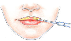 Увеличение губ - Пластический хирург Ткач Олег Сергеевич Увеличение губ
