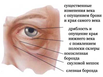 Блефаропластика (пластика век) - Пластический хирург Ткач Олег Сергеевич Блефаропластика (пластика век)