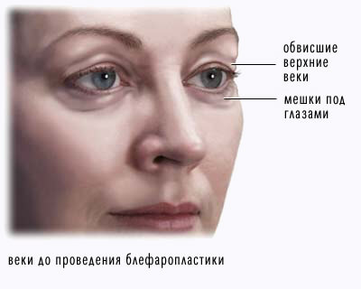 Блефаропластика (пластика век) - Пластический хирург Ткач Олег Сергеевич Блефаропластика (пластика век)
