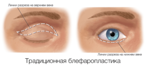 Блефаропластика (пластика век) - Пластический хирург Ткач Олег Сергеевич Блефаропластика (пластика век)
