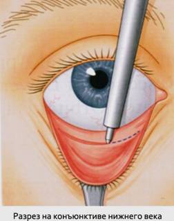 Блефаропластика (пластика век) - Пластический хирург Ткач Олег Сергеевич Блефаропластика (пластика век)