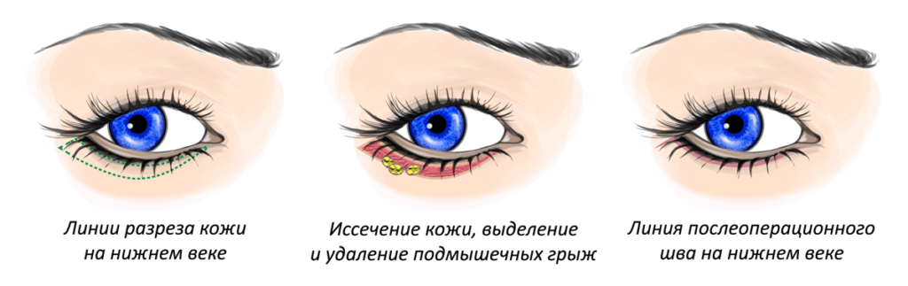 Блефаропластика (пластика век) - Пластический хирург Ткач Олег Сергеевич Блефаропластика (пластика век)