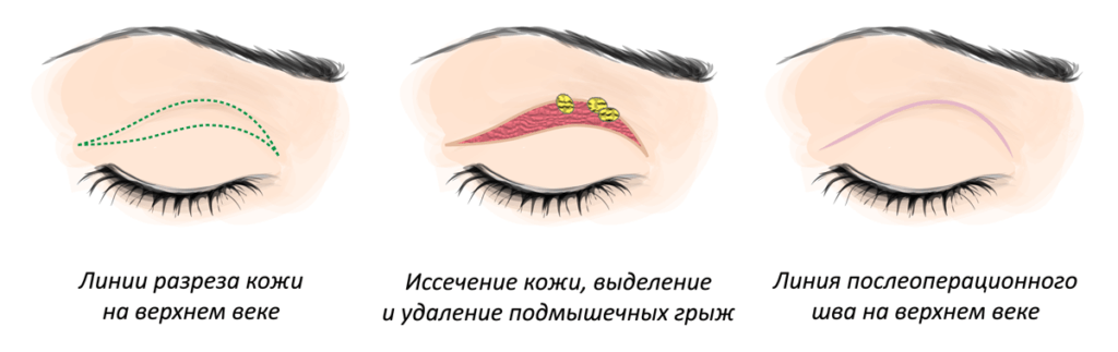 Блефаропластика (пластика век) - Пластический хирург Ткач Олег Сергеевич Блефаропластика (пластика век)