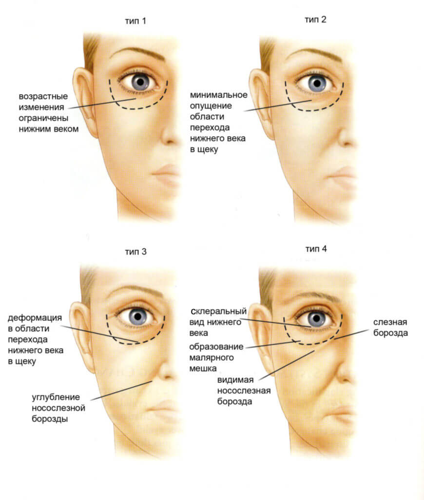 Блефаропластика (пластика век) - Пластический хирург Ткач Олег Сергеевич Блефаропластика (пластика век)