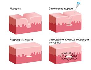 Инъекции Гиалуроновой Кислоты - Пластический хирург Ткач Олег Сергеевич Инъекции Гиалуроновой Кислоты