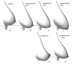 Підтяжка Грудей, Мастопексія - Пластический хирург Ткач Олег Сергеевич Підтяжка Грудей, Мастопексія
