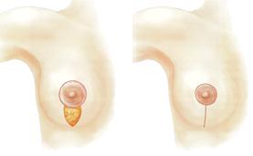 Уменьшение груди - Пластический хирург Ткач Олег Сергеевич Уменьшение груди