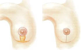 Уменьшение груди - Пластический хирург Ткач Олег Сергеевич Уменьшение груди