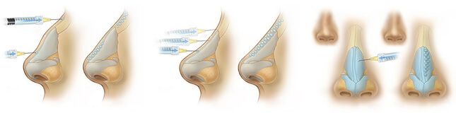 Инъекции Гиалуроновой Кислоты - Пластический хирург Ткач Олег Сергеевич Инъекции Гиалуроновой Кислоты